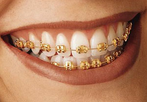 Gold braces